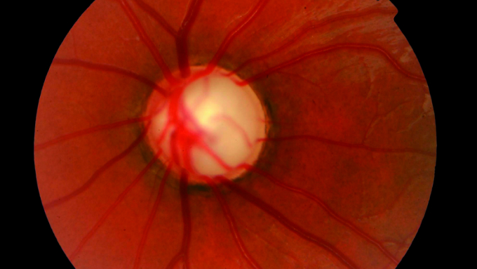 Glaucoma congénito - Sandra Echarri - Médica Oftalmóloga